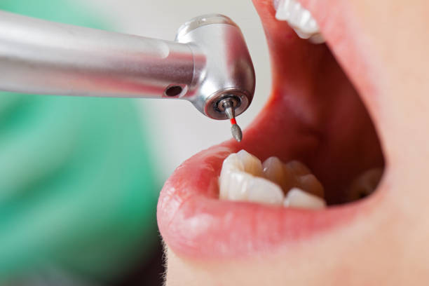 Best Chipped Tooth Repair Near Me  in Williston, SC